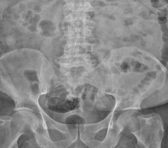 Figure 1: Abdominal X-ray (AP view).