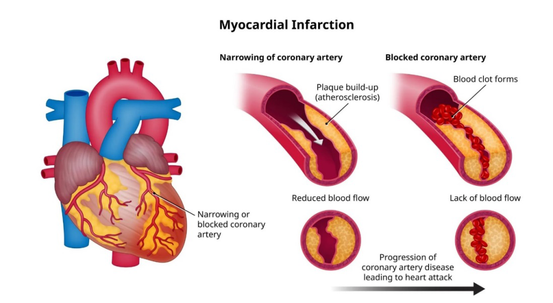 Figure 1: Myocardial Infarction.