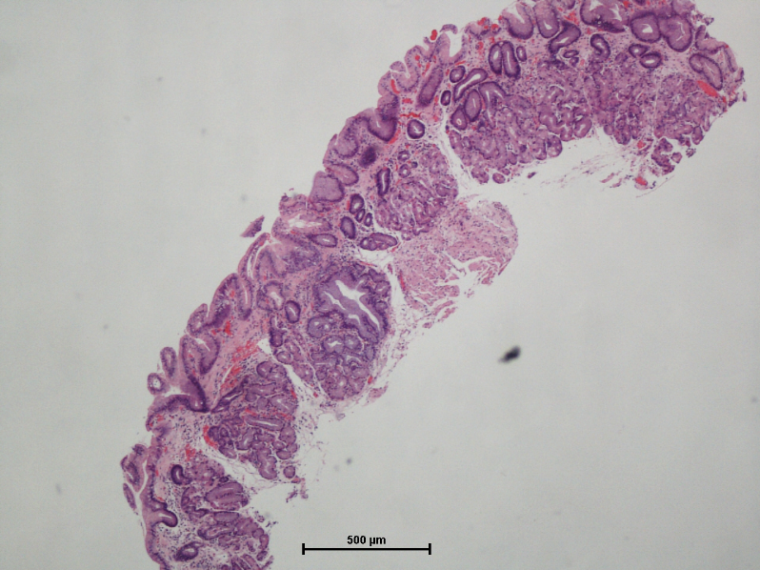 Figure 1: Low magnification of GEJ biopsy shows thick subepithelial collagen (left) confirmed with trichrome stain (right).