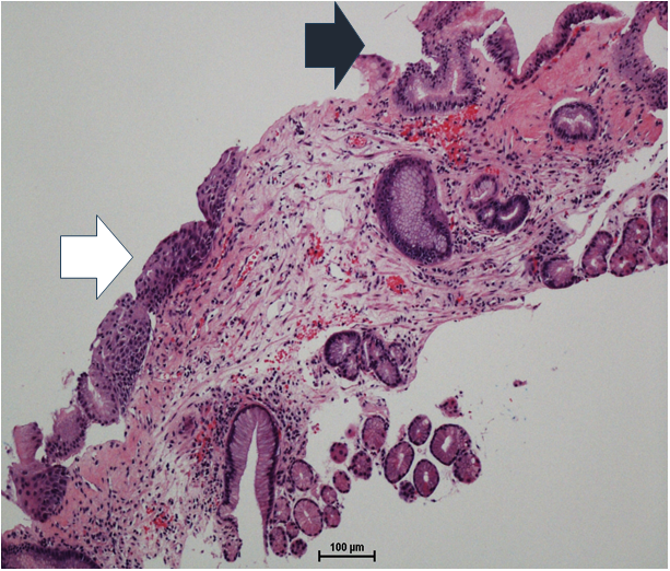 Figure 3: Collagen fibers focally extended into deeper lamina propria and surrounded glands/pits (left) confirmed with trichrome stain (right).