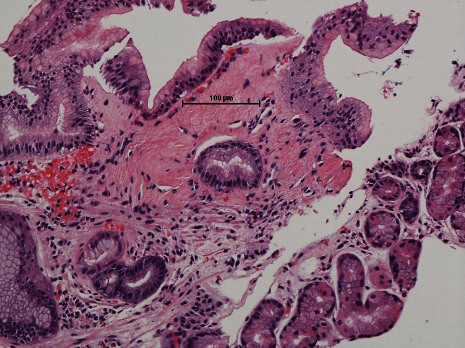 Figure 5: Gastric oxyntic mucosa with PPI effects.