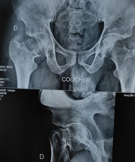 Figure 1: Reported a trochanteric fracture treated by DHS.