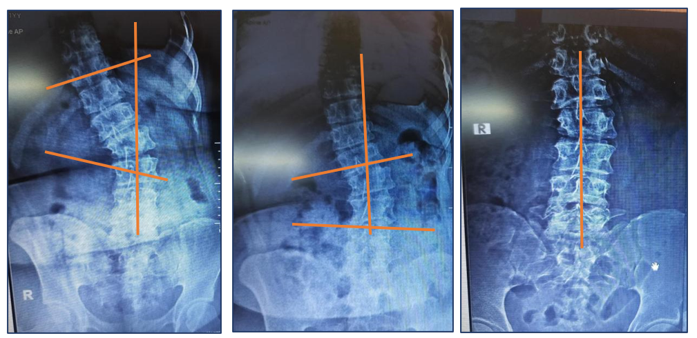 Figure 1: X-rays of spine showing curvature corrections.