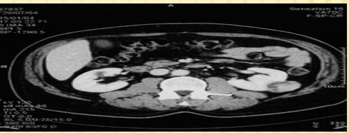 Figure 2: Renal computed tomography performed 2 years after the first. Left kidney lesion, tumor-type, without fat contingent, heterogeneous, enhanced after injection.