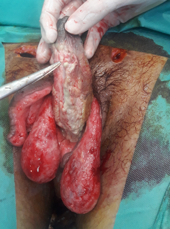 Figure 2: Regression of necrosis after necrosectomy.