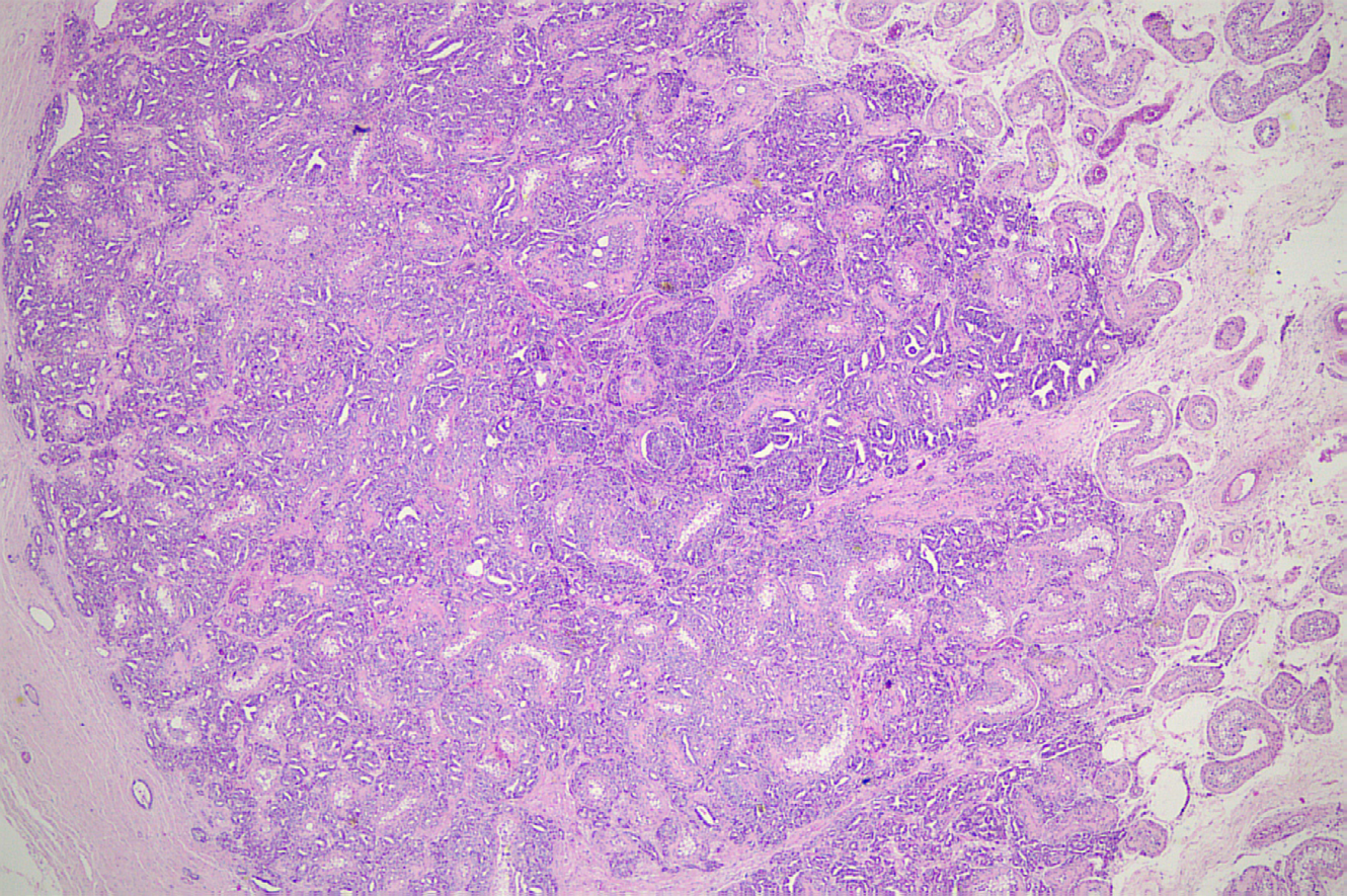 Figure 1: Anatomopathological examination of the right testis. (HE-Stained, 20x).
