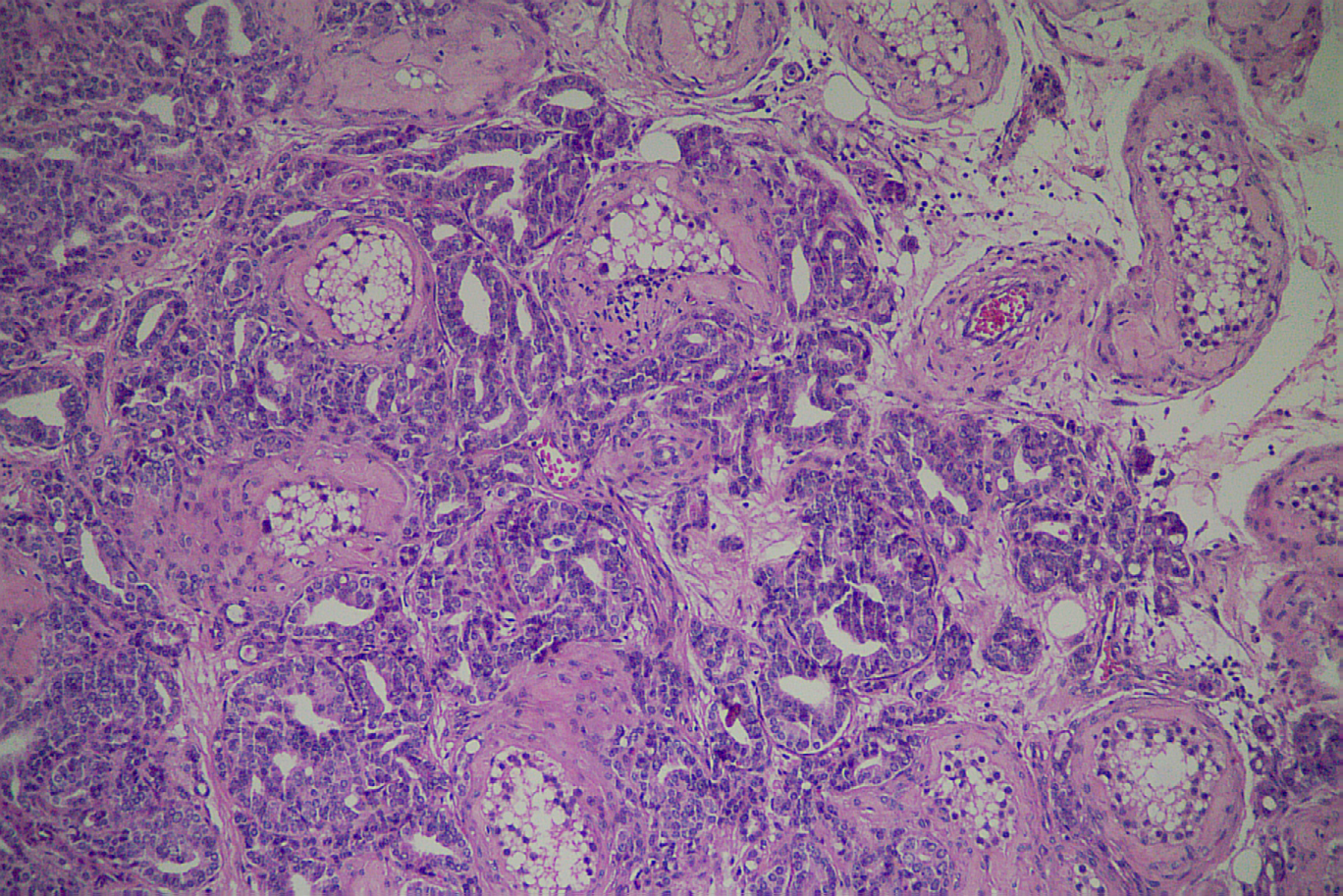 Figure 2: Anatomopathological analysis of the right testis. (HE-Stained, 100x).
