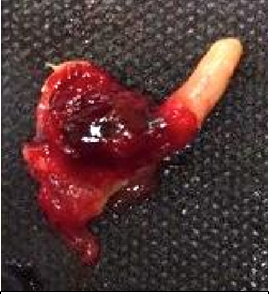 Figure 10: Hemorrhagic Infiltration of the Hyoid Bone on the Left Great Horn of C Body.