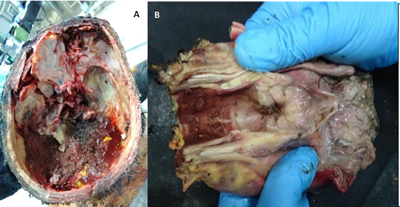 Figure 12: Photographic Findings of the Judicial Autopsy on F’s Body. A: Complex Fractures of the Skull Base and of the Anterior Cranial Fossa Bilaterally, of the Left Middle Cranial Fossa, with Structural Loss of the Posterior Cranial Fossa where there was a Conspicuous Thickened Hematoma. B: After Excision and Analysis of the Tongue-Hypopharynx-Larynx Block, there was no Endoluminal Carbonaceous Material, But only Cooked Blood Stratification Indicative of Cadaveric Charring.