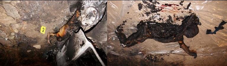Figure 4: Photographic Surveys of Judicial Inspections. A: The Corpse was Found Lying Supine, in a Wrestler-Type Position Next to an Off-Road Vehicle, Completely Burned. B: The Body was Placed on a Plastic Sheet in Order to Complete the Cadaveric Inspection and to avoid the Dispersion of Organic Material. The Physiognomic Features were not Identifiable Due to 4th Degree Face Burns. The Entire Left Hemithorax, the Left Side of the Abdomen, the Pelvis and the Left Lower Limb from the Middle- Distal Third of the Thigh were Missing. Regarding the Right Lower Limb, It was Disarticulated at the Knee Level and a Calcified Tibial Fragment was Found next to the Body. The Right Thoracic Wall, the Central Wall B the Trunk and the Volar Surface of the Right Limb were Intact.