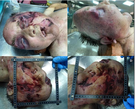 Figure 8: Judicial Autopsy Photographic Findings on C Body. Both the Eyeballs, Especially the Left One, were Sunken in their Respective Orbits with Bilateral Periorbital and Orbito-Zygomatic Ecchymosis and Hematoma (A). The Skull’s Anatomic Shape was Deformed due to Multi-Fragmentary Fractures of the Bones of the Facial Massif, Most Appreciable on the Left Side. There was a Group of Ecchymotic Abrasions with Some Lacerated Wounds on the Left Chin, In the Left Frontal Region and the Left Orbito- Zygomatic Region which were Heavily Bruised and Contused (B, C and D).