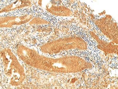 Figure 3: Endometrial tissue sample showing a strong IGF-1 receptor positivity 200x. There was a strong correlation between the levels of expression for IGF-1R and ER in the stroma (p = 0.025). There was no significant correlation between IGF-1R and the HOMA-IR index (p = 0.7932), but there was a correlation with AC (p = 0.0080) in gland cells. Staining for PR in gland cells also correlated with AC (p = 0.0261). Table 2 summarizes the correlations between PR, IGF-1R and AC. There was an inverse correlation between IGF-1R and the levels of serum estrogen (p = 0.0410; r = -0.224).