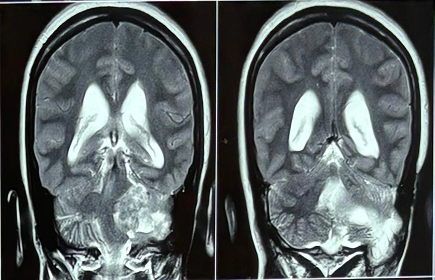 Figure 1: MRI brain, a well-defined lobulated extra axial mass lesion noted at left CP angle.