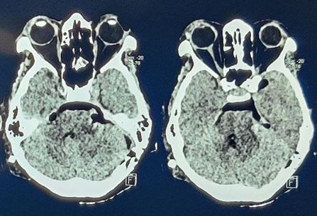 Figure 6: MRI brain shows a well-defined hypointense, heterogenously hyperintense solid-cystic extra-axial lesion.