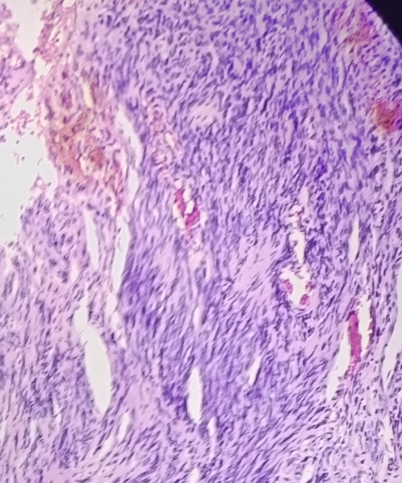 Figure 8: Tumor composed of highly cellular, compact areas of Antoni A with variable hyperchromasia and pleomorphism (Haematoxylin & Eosin stain, 40x).