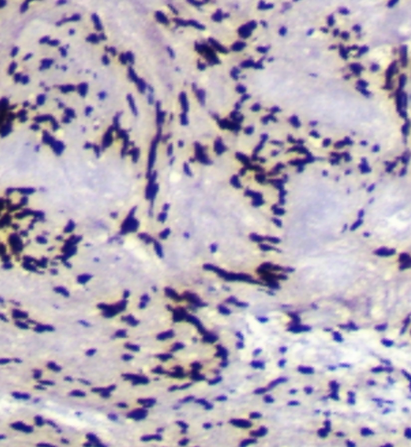 Figure 9: Immunohistochemistry tumor shows SOX10 positivity.