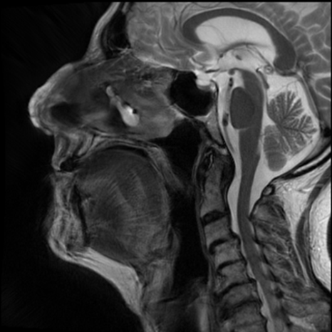 Figure 3: MR Head and neck showing thickening and heterogenous enhancement of the entire nose dorsum.
