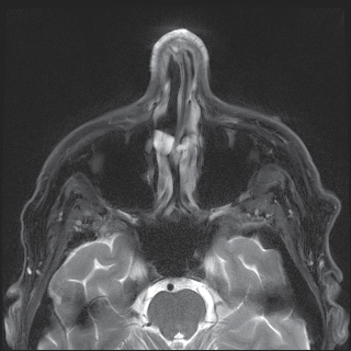 Figure 4: MR Head and neck showing Thickening and heterogenous enhancement of the bilateral nasal walls.
