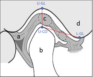 Figure 1: In the mandibular fossa or glenoid cavity, the highest point in relation to the condyle head or the apex of the ellipse within the mandibular fossa of the temporal bone was marked. We named this the upper glenoid (U-GL). At the lowest anterior point of the anterior joint eminence or transverse root of the zygoma, we marked a point that we named the lower glenoid (L-GL) Figure 1.