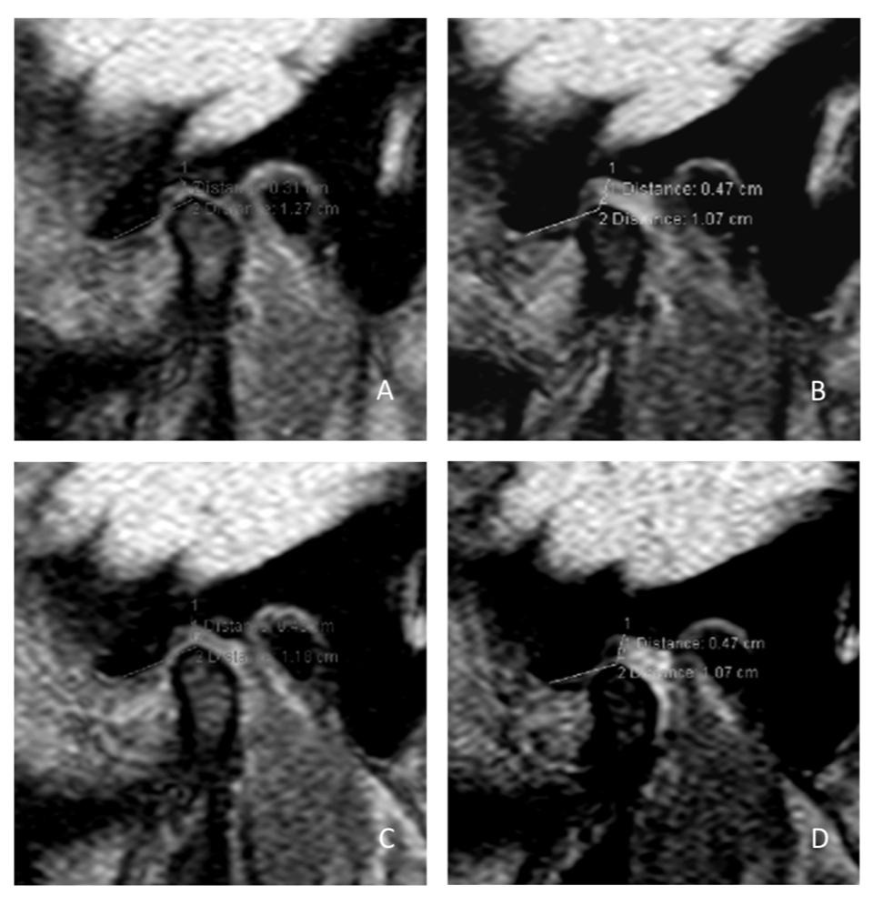 Figure 2: The RMI of TMJ: A - with closed mouth without appliance; B - with opened mouth without appliance; C - with closed mouth with appliance and D - with closed mouth with appliance.