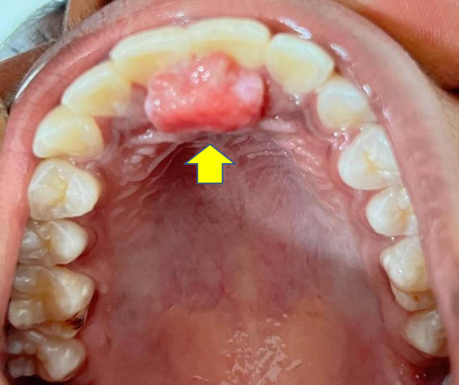 Figure 1: Intraoral photograph showing small soft tissue swelling at the incisive papilla behind the two central incisors (Yellow arrow).