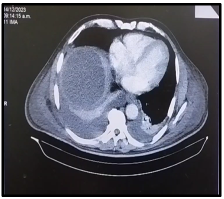Figure 2: Contrast-enhanced CT scan, arterial phase, showing a hepatic abscess with an approximate volume of 1,800 cc.