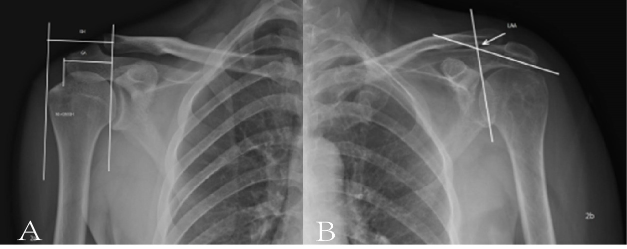 Figure 2: Schematic Diagram of AI and LAA (A, B). A: Distance from the Outermost Border of the Acromion of the GA to the Glenoid Tangent; Distance from the Most Lateral Margin of the Humeral Head to the Glenoid Tangent, AI=GA/GH; B: LAA Measurements (Arrows).