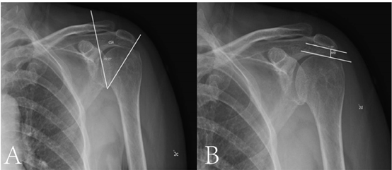 Figure 3: CSA, AHD (A, B).
