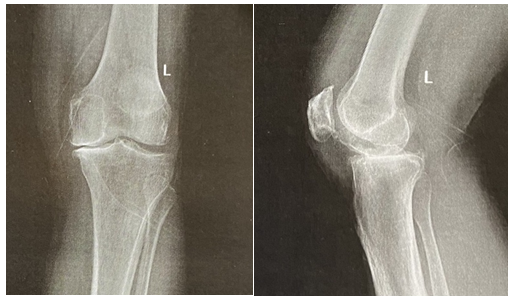 Figure 1: Preoperative left knee showing medial compartment osteoarthritis.