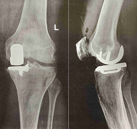 Figure 2: Postoperative left knee with well fixed prosthesis.