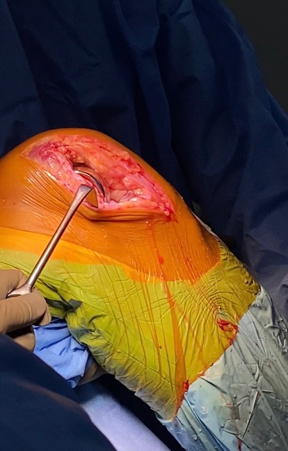 Figure 3: Bone preparation.