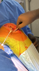 Figure 6: Bone removed from medial tibial plateau.