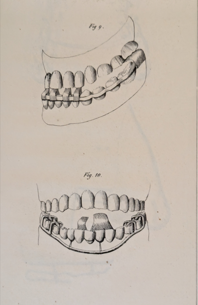 Figure 1: Catalan appliance after Delabarre CF.