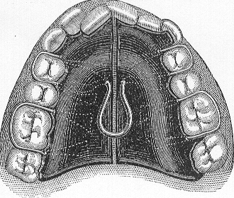 Figure 13: Hamilton HF dental models before and after treatment.