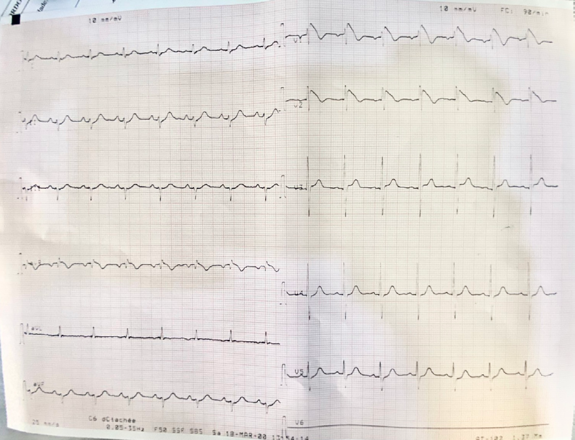 Figure 2: ECG 24 Hours Later, the Patient was Still Febrile.