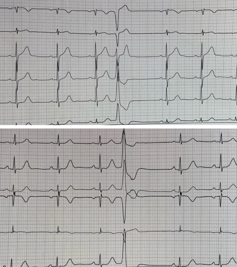 Figure 4: No Sinus Node Dysfunction, Normal HV Interval of 53 Ms, Programmed Electrical Stimulation. On the EP study, there was No sinus node dysfunction, normal HV interval of 53 ms, programmed electrical stimulation (PES) with standard protocol and with right ventricle, apex and RVOT aggressive protocol did not triggered ventricular arrythmia.