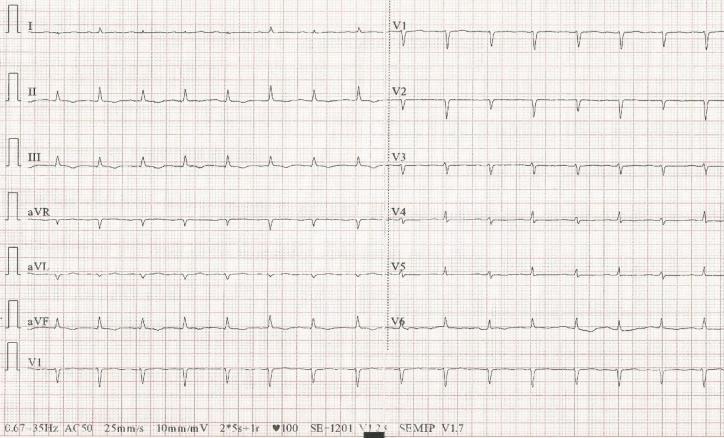 Figure 1: One of our patients ECG showing aregular sinus rythm, low QRS voltage and electric alternance.
