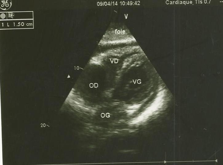 Figure 4: Echocardiography showing a significant decrease of the pericardial effusion after pericardiocentesisin one of our cases. The evolution under treatment is a valuable argument in the management of this complication in our working context as in the African series [14]. Mortality was high, hospitalized at 20.0% and overall mortality at 6 months of 32.5%. This is in practice related to delay in seeking healthcare, diagnostic problems, the underlying or predisposing factors, the cause, the therapeutic difficulties and the modest resources of the patients. During the follow-up 4 cases (10%) of chronic pericarditis were noted. Indeed, chronic constrictive pericarditis must always be of concern. Imazio [15] reported in a study of a cohort of 500 cases of pericarditis a constriction rate of 31.65 per 1000 for tuberculous pericarditis. This rate could reach 52.74 per 1000when they became purulent.