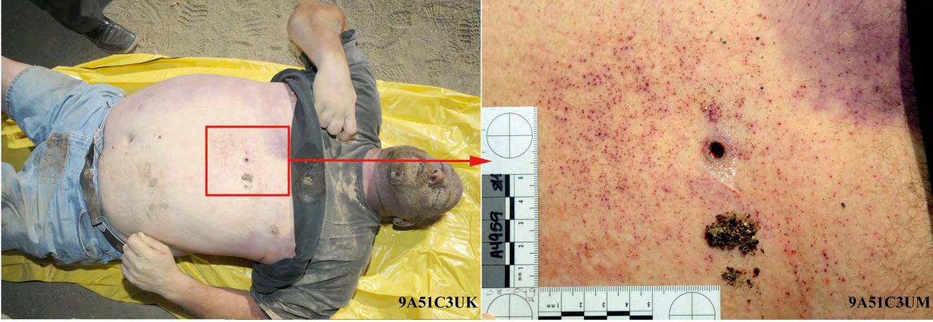 Figure 2: Left, deceased Adam Owen at the scene. Right, close-up image of the bullet wound in Owen’s chest showing gunpowder stippling around the entrance wound, which indicates the muzzle was at an intermediate range to him when fired; the S&W revolver and ammunition require test firing at different target distances to estimate the muzzle-target distance.