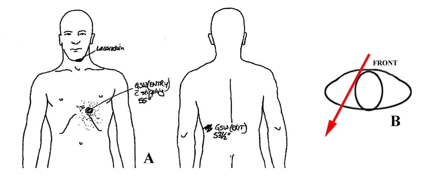 Figure 7: Adam Owen’s bullet wounds and trajectory. A. Left, anterior view of the autopsy drawing showing the location of the entrance wound and associated stippling; right, posterior view showing the location of the exit wound. From the Adam Owen autopsy report [4]. B. Estimated trajectory (from A and B) through Owen’s body, indicating that Owen was rotating counterclockwise when he was shot, assuming that he initially faced Flechtner.