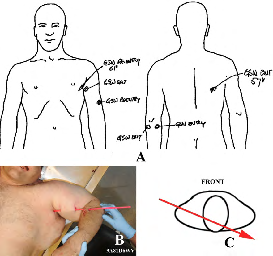 Figure 8: Robert Light’s bullet wounds and trajectory. A. Left, anterior view of the body in the autopsy drawing showing the location of the entrance wound in the chest after passing through his left arm; right, posterior view showing the exit wound location. From the Robert Light autopsy report [4]. B. Image before autopsy and after the body was cleaned shows the bullet path through the left arm; the position of the upper arm was perpendicular to the body, and the forearm was down, as shown by the arm position with the trajectory rod in place. C. The bullet trajectory through Light’s body (estimated from the drawings A and B); Light was rotating clockwise when he was shot. Robert Light: Bullet Trajectory The Light autopsy report states, “The bullet path from the left axilla passes through the lateral aspect of the left fourth rib, continues through the left upper lung lobe, across the mediastinum, grazing the left atrium and aortic arch, continuing through the right lung and through the posterolateral aspect of the right fifth rib to the exit wound in the back. The aortic arch, though grazed, is not perforated. There is equivocal perforation of the left atrial wall” [4]. The entrance and exit bullet wounds and bullet trajectory are illustrated in Figure 8. Since Light was wearing only a t-shirt, he, like Owen with a similar chest wound, started dripping blood within seconds of his wounding. The first blood drop occurred when he was on the rocky part of the driveway just off the concrete of the driveway. He likely stumbled to the chain link fence east of the driveway and then maneuvered along the fence to collapsing on the north side of the road (Figure 1).