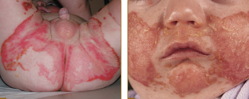 Figure 1: Acrodermatitis enteropathica clinical presentation after 2 weeks of zinc supplementation.
