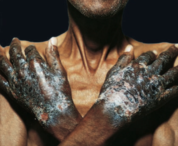 Figure 3: Exudative Glove/Gauntlet Lesion on Vitamin B3 Deficiency.