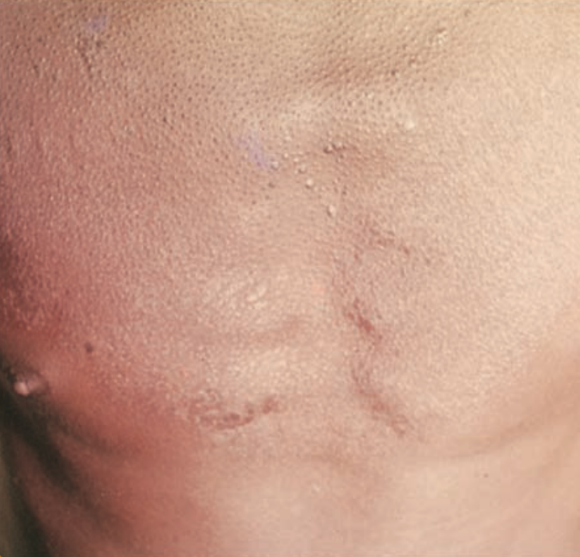 Figure 4: Chest perifollicular hyperkeratosis on vitamin A deficiency.