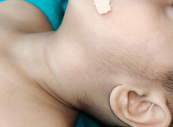 Figure 1: Clinical picture of a child with left lateral neck swelling (marked by black arrow).