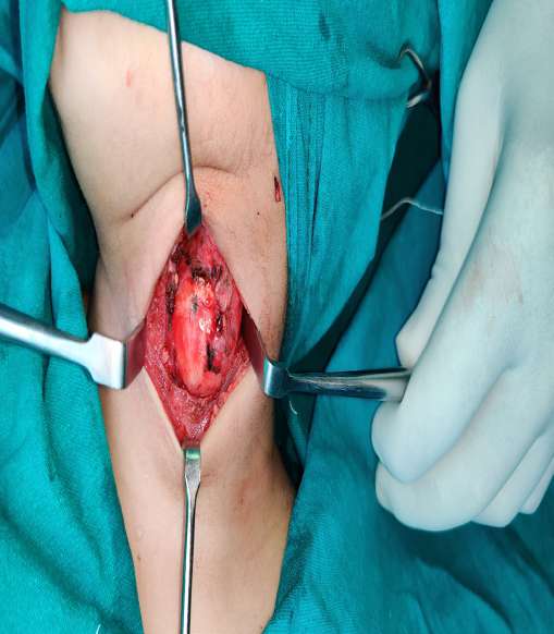 Figure 3: An intraoperative image displaying the cyst and its wall following a meticulous dissection of the surrounding tissue.