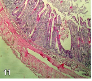 Figure 11: Section in the caecum from group (2) chicks showing one crypt abscess composed of Eimeria schizont and chronic inflammatory cells (H&E X250).