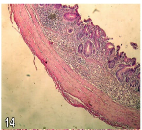 Figure 14: Section in the caecum from group (4) chicks showing submucosal invasion of schizont with transmural inflammation affecting all layers of intestinal wall (H&E X100).