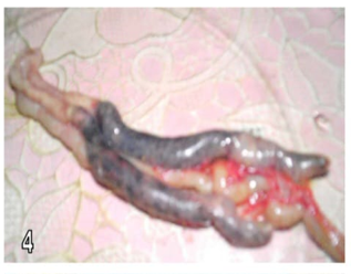 Figure 4: Caeca distended with blood in chicks of group (4) at the 6th day post infection.