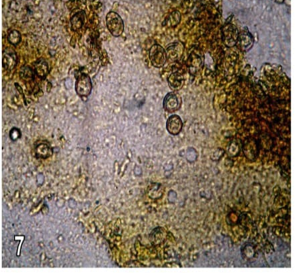 Figure 7: Caecal mucosal scraping showing heavy infection with oocysts from control chicks of group (5) at 38th day (X10).
